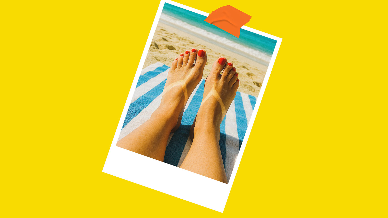 Photo of a womans feet who has a sunburn in the shape of thongs