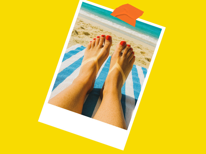 Photo of a womans feet who has a sunburn in the shape of thongs